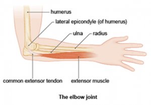 elbow tendonitis