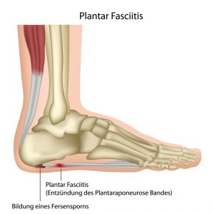 Plantar Fasciitis Ankle Sleeve